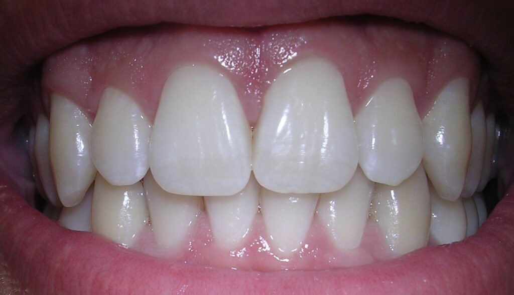 Sonrisa natural con dientes alineados usada como referencia estética dental