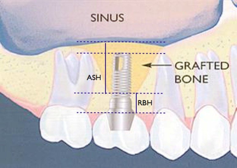 Esquema de elevación de seno maxilar con injerto óseo e implante dental