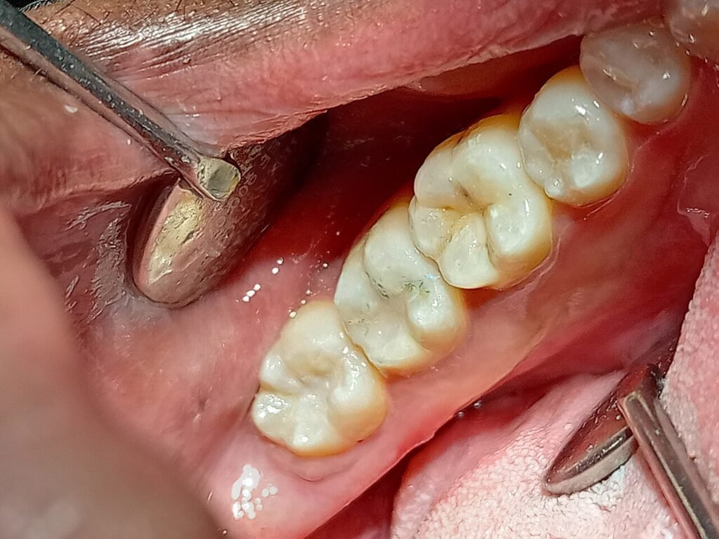 Molares y premolares con selladores dentales transparentes aplicados en fisuras