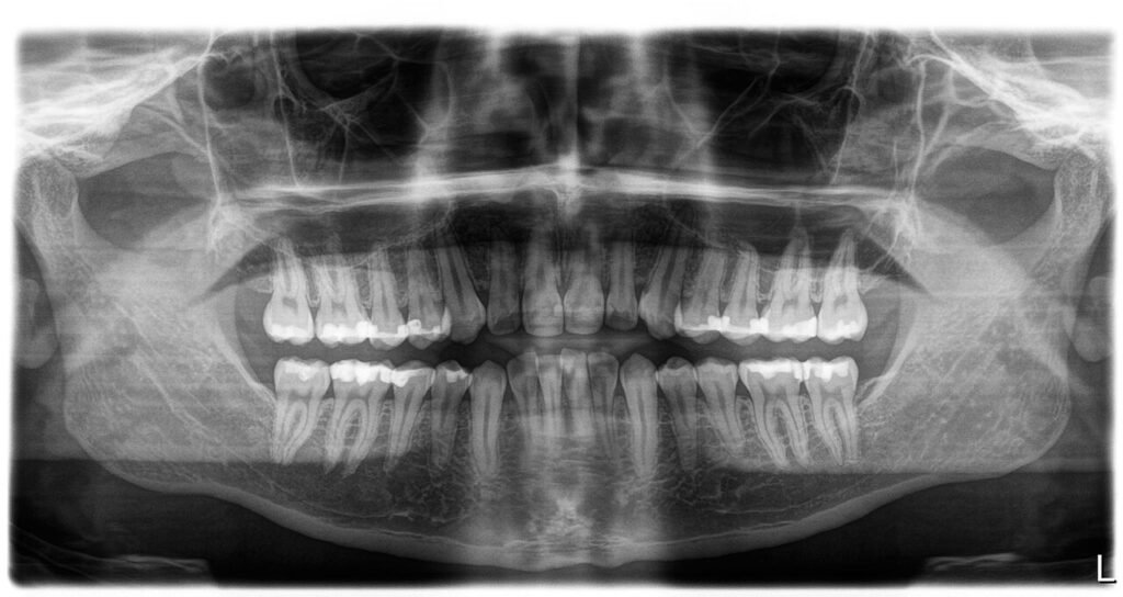 Radiografía panorámica dental con maxilar superior, mandíbula y piezas dentales visibles