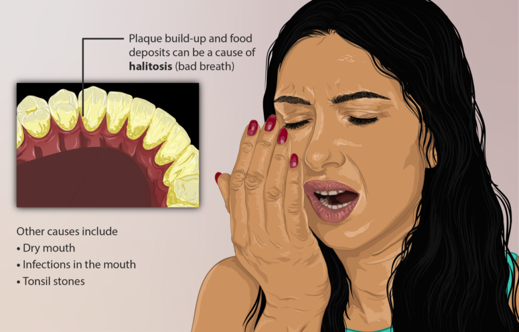 Ilustración clínica sobre halitosis, placa bacteriana, boca seca e infecciones bucales