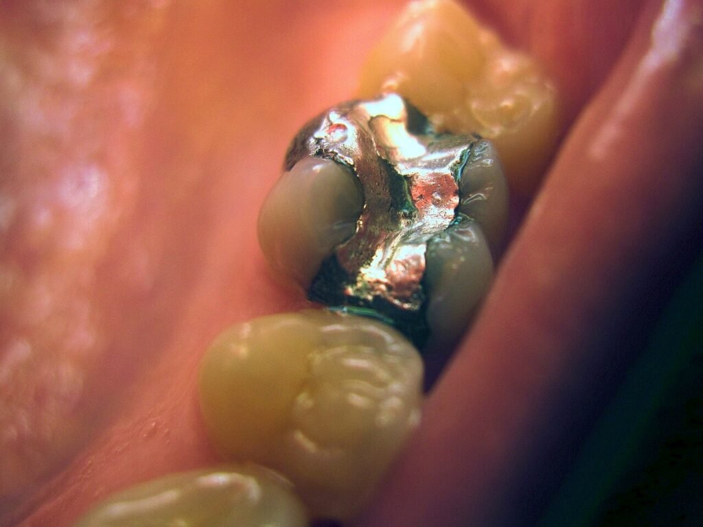 Primer plano de un molar con restauración de amalgama dental metálica
