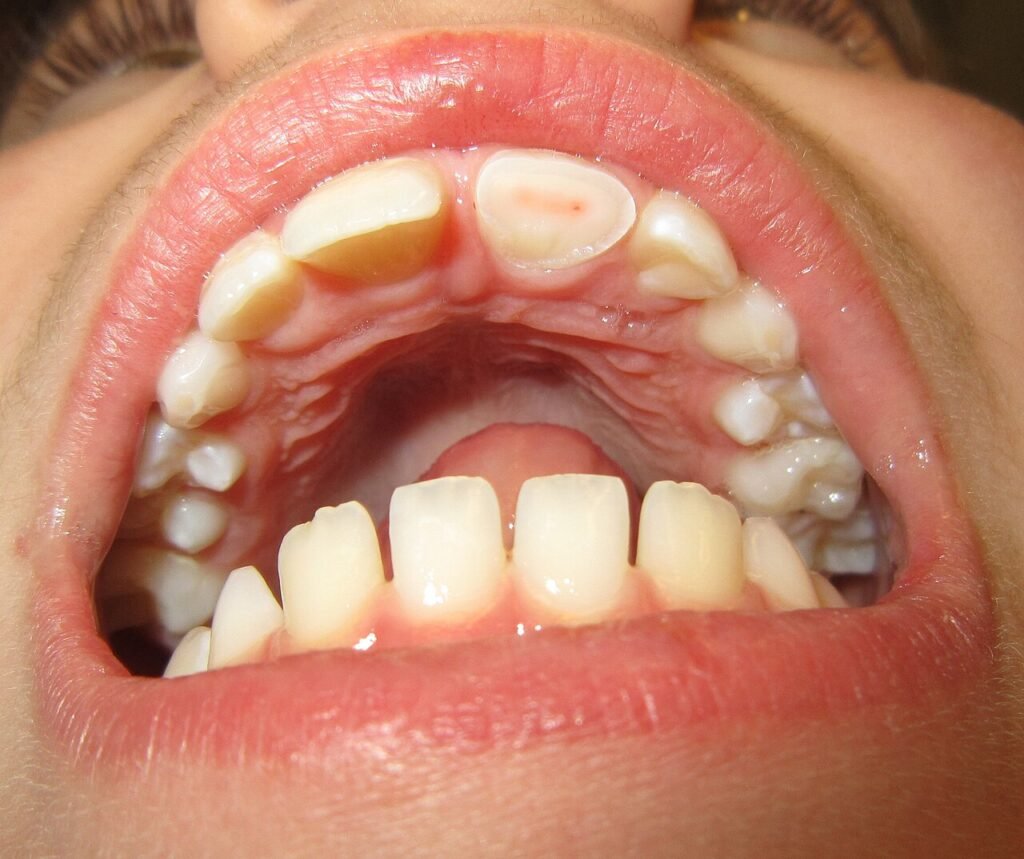 Diente frontal superior roto con fractura coronaria y exposición de capas dentales