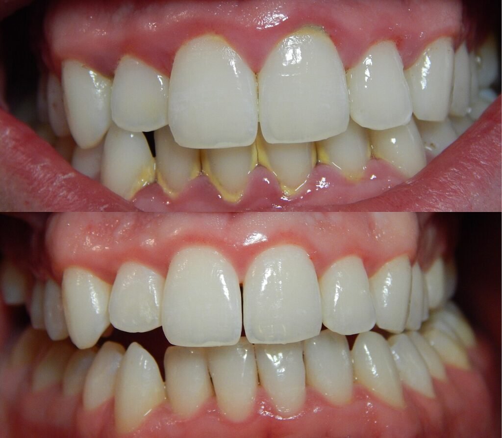 Encías antes y después de tratamiento periodontal con mejora visible de inflamación y placa