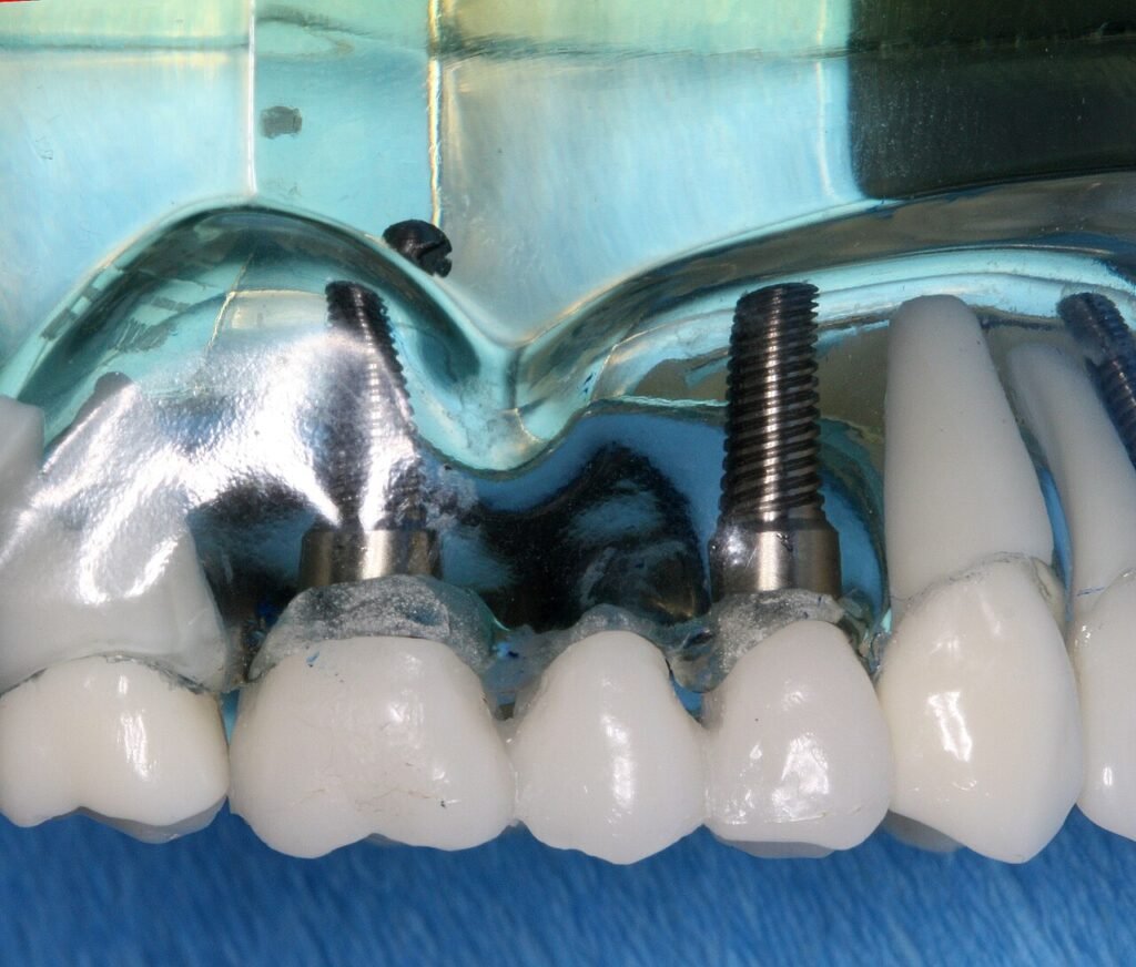 Modelo dental con puente fijo sobre implantes para explicar los tipos de puente dental