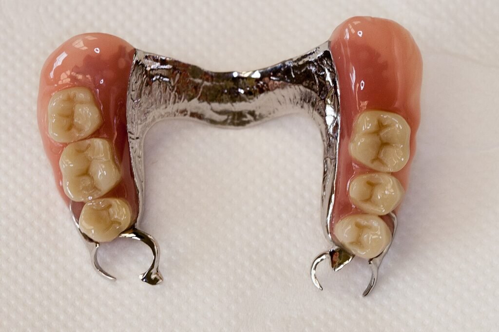 Prótesis dental removible parcial superior con estructura metálica y dientes artificiales