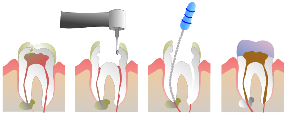 Ilustración del proceso de endodoncia en un molar con limpieza de conductos y restauración final