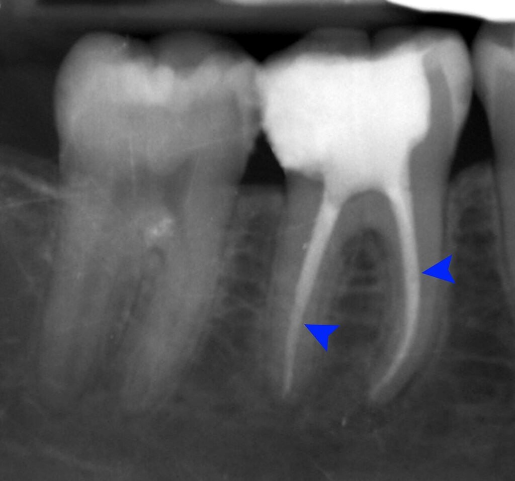 Radiografía dental de una pieza con tratamiento de conductos y restauración temporal