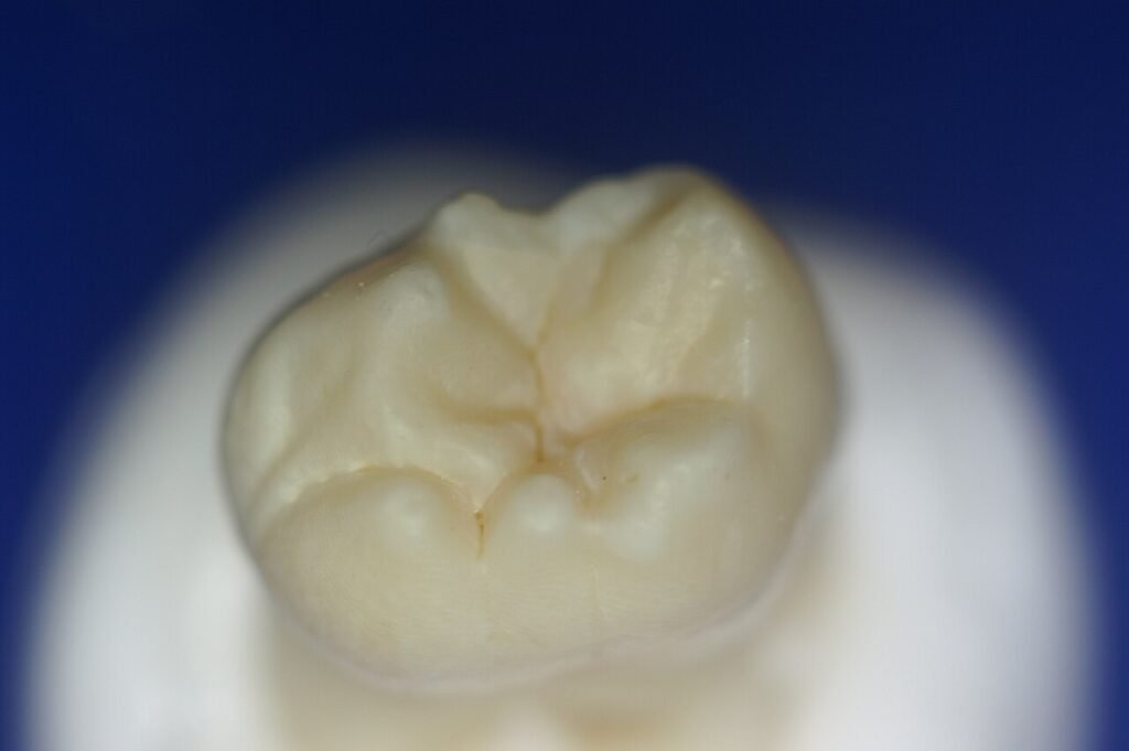 Molar infantil con surcos y fisuras donde pueden aplicarse selladores dentales preventivos