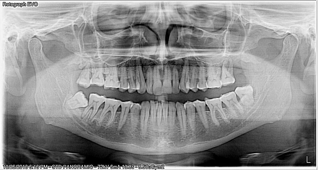 Radiografía panorámica dental con dientes, raíces y huesos maxilares
