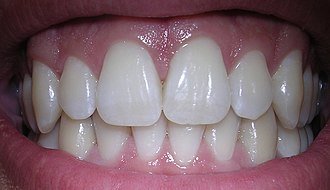 Sonrisa natural con dientes anteriores alineados y encías sanas