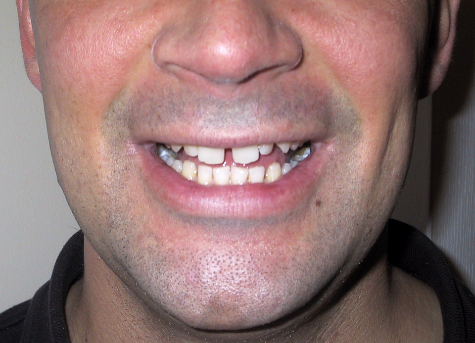 Sonrisa con diastema central entre los incisivos superiores