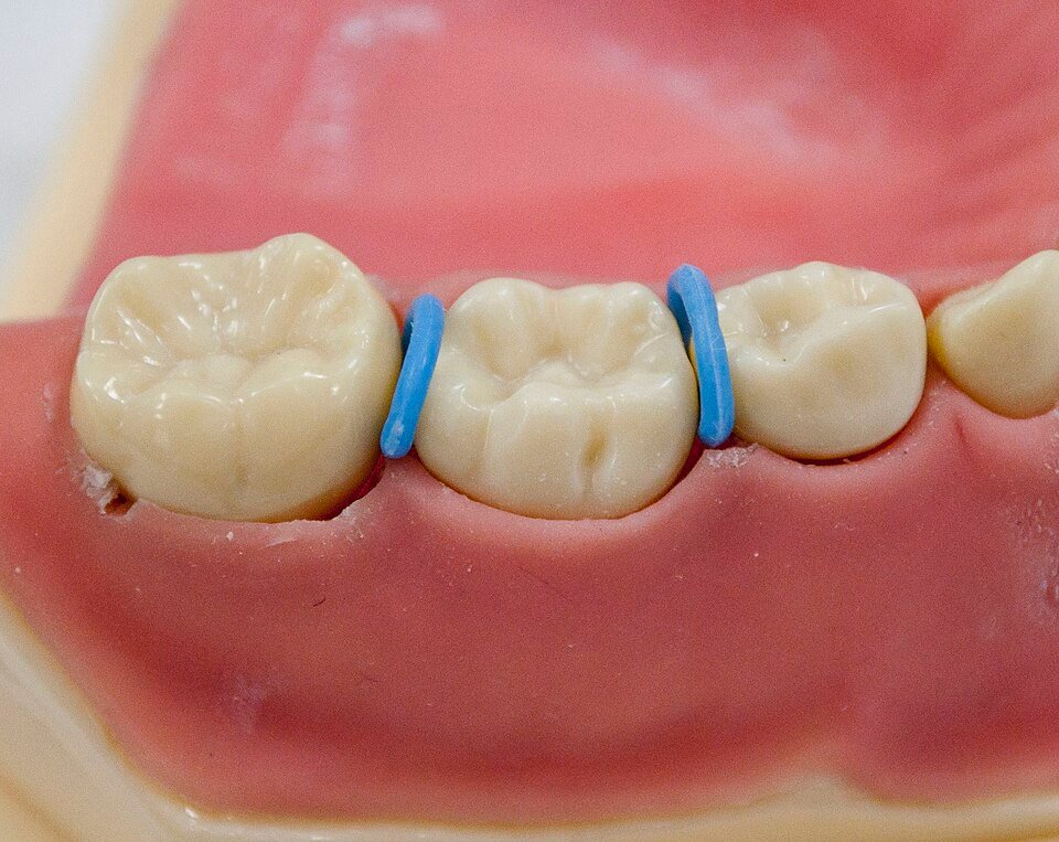 Modelo dental infantil con separadores que ilustran el control del espacio entre dientes de leche