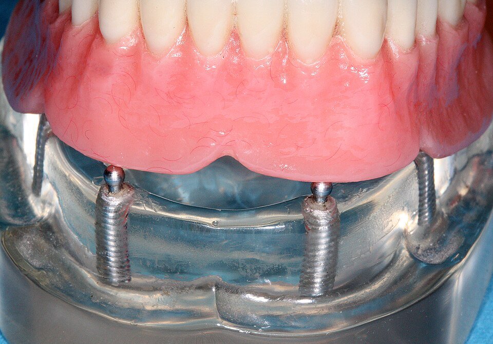 Modelo de sobredentadura dental retenida por implantes sobre mandíbula