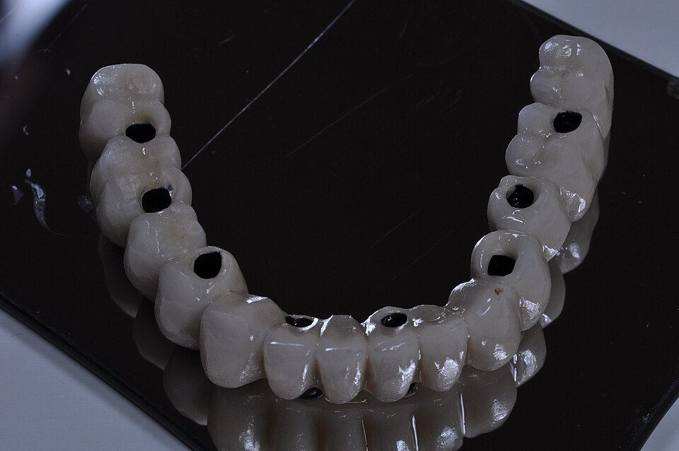 Prótesis fija sobre implantes dentales realizada en metal porcelana