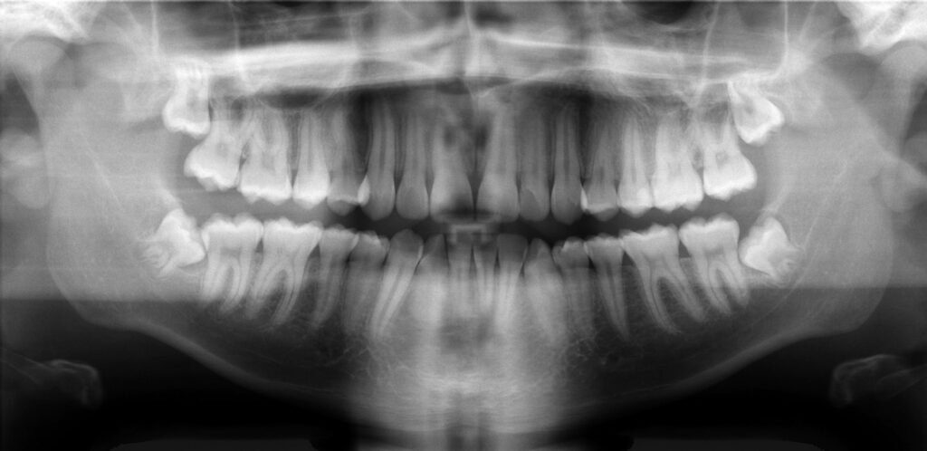 Radiografía panorámica dental con cordales incluidos en mandíbula y maxilar