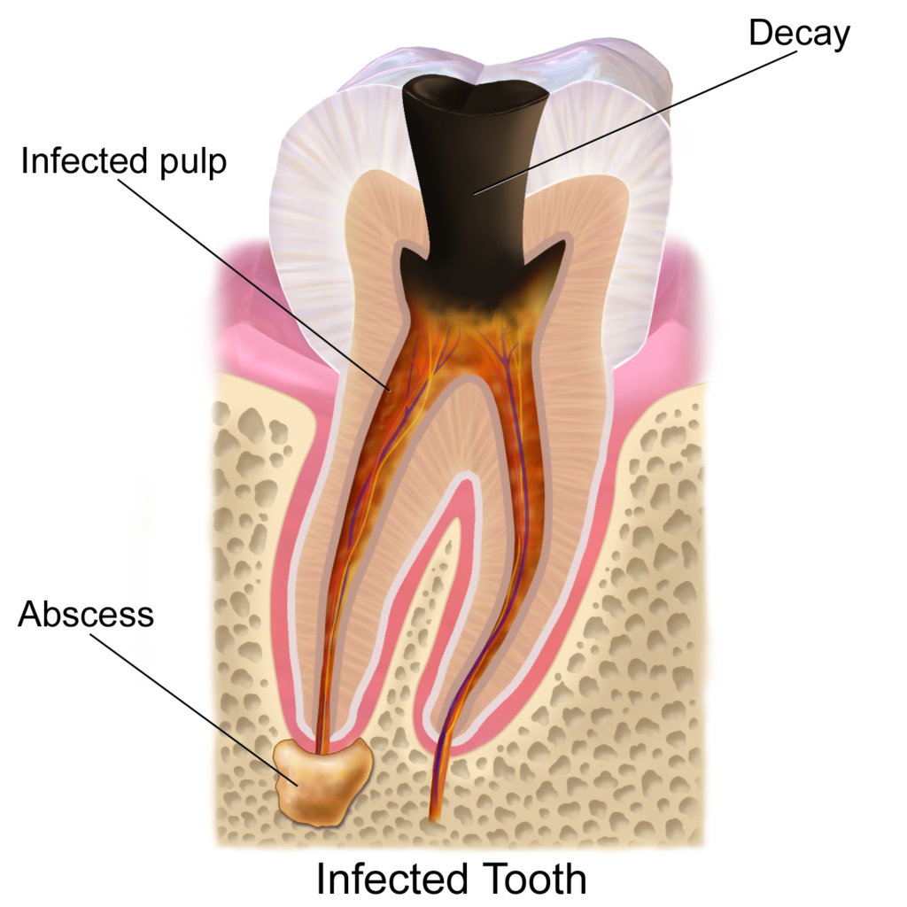 Ilustración de caries dental avanzando desde el esmalte hacia la dentina y la pulpa