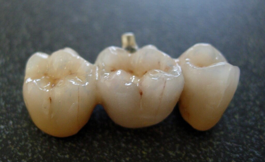 Puente dental cerámico de tres piezas usado para reponer un diente perdido