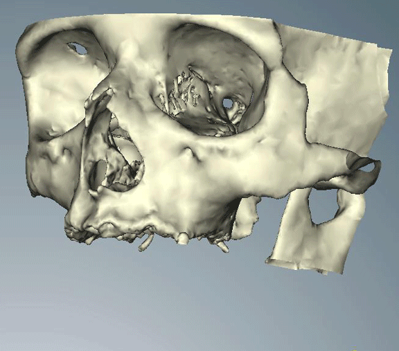 Planificación digital CAD CAM para colocar implantes dentales con guía quirúrgica