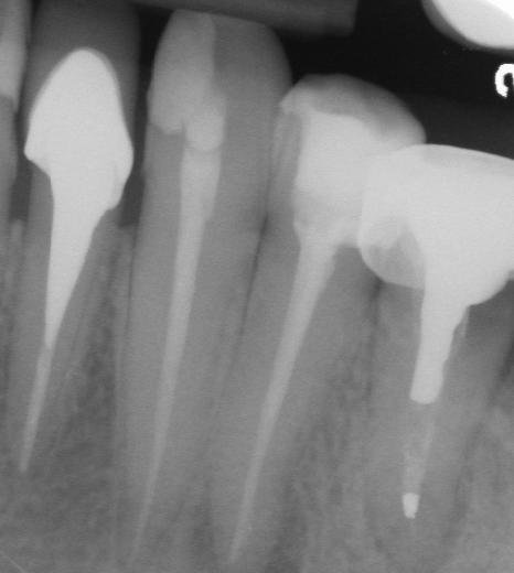 Radiografía dental con poste intrarradicular cementado en una pieza tratada