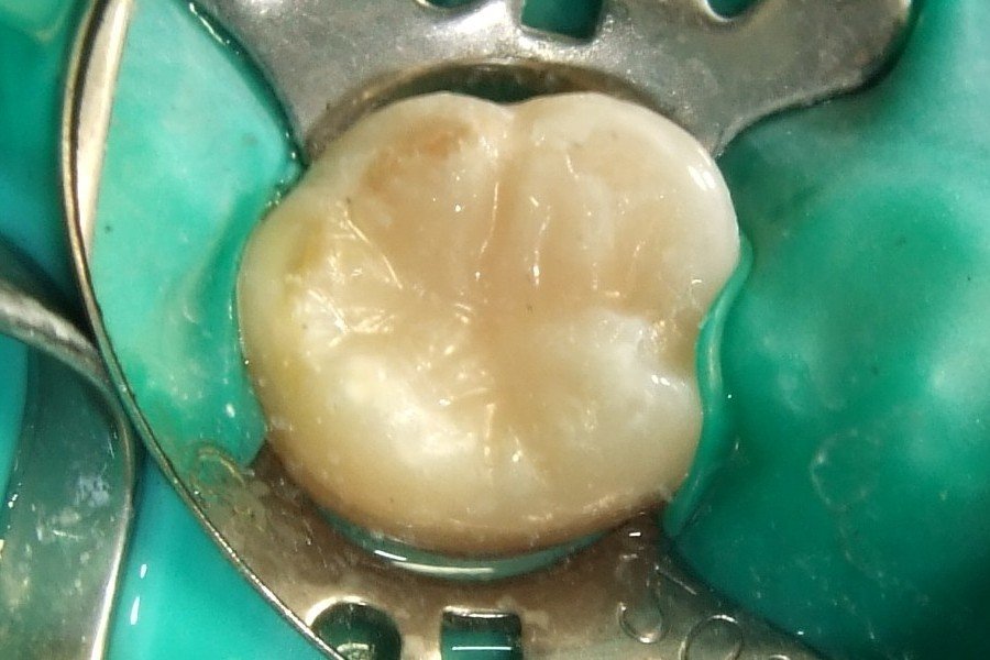 Restauración dental con resina compuesta en una muela