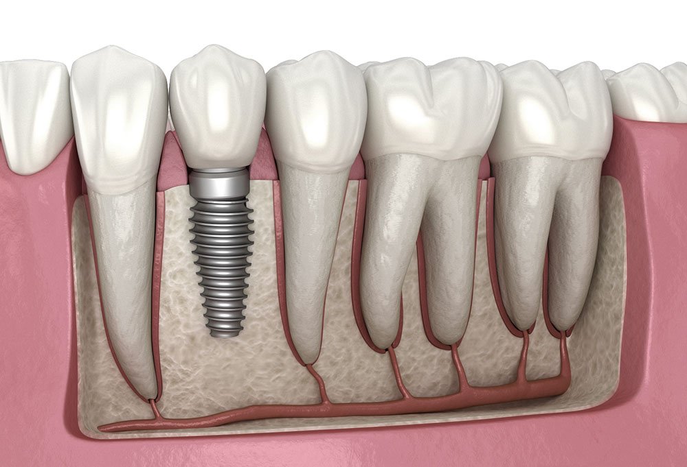 Ilustración 3D de un implante dental integrado en hueso maxilar