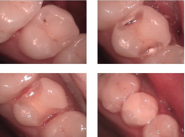 Restauración dental con composite en una muela después de reparar una cavidad
