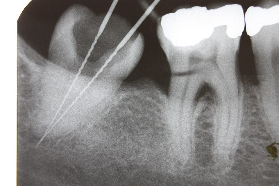 Radiografía dental con instrumentos de endodoncia dentro de conductos radiculares