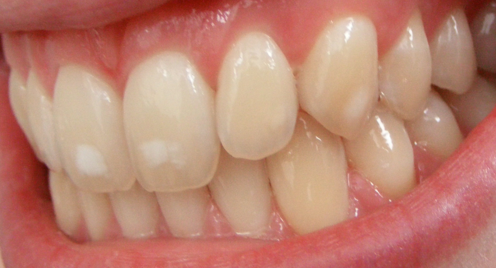 Manchas blancas leves en esmalte dental relacionadas con fluorosis y posibles tratamientos estéticos conservadores