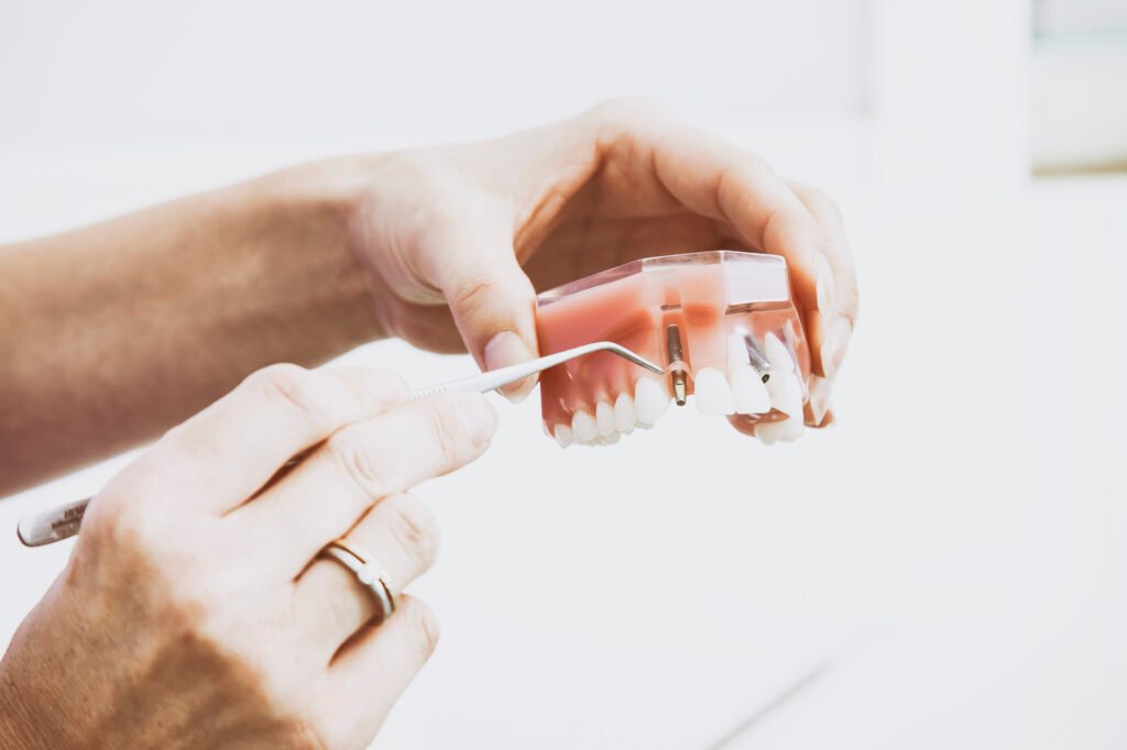 Modelo dental con implantes para explicar la base ósea necesaria antes de una rehabilitación oral