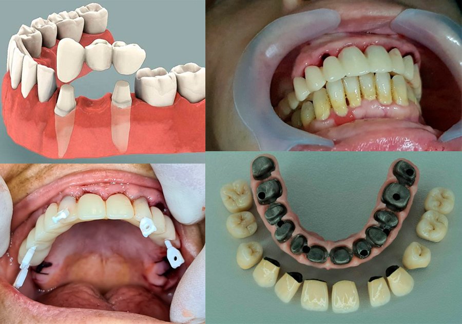 Tipos de dentaduras postizas completas y parciales para rehabilitación dental