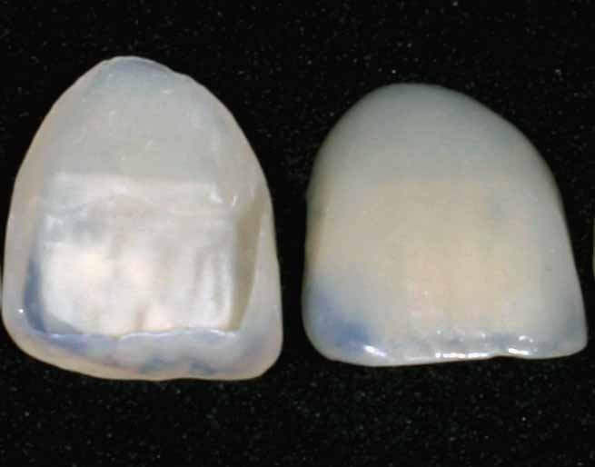 Carilla dental de porcelana vista de cerca sobre fondo oscuro