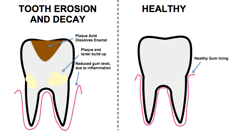 Diagrama comparativo entre un diente sano y un diente con erosión dental