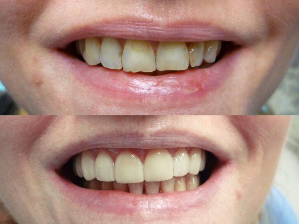 Comparación clínica de carillas dentales antes y después como ejemplo de armonización de sonrisa