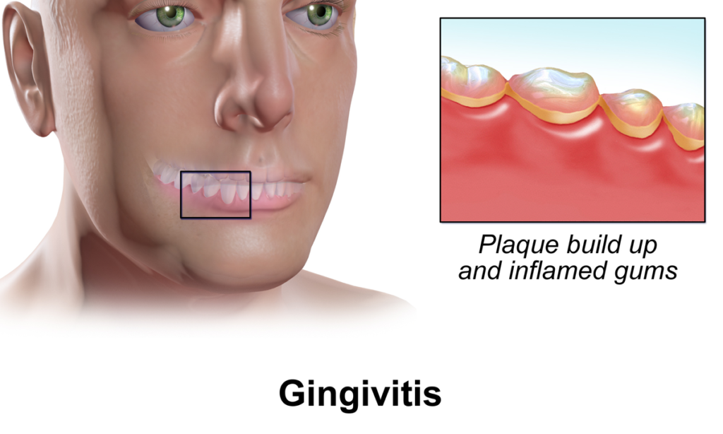 Ilustración médica de gingivitis con placa e inflamación de encías