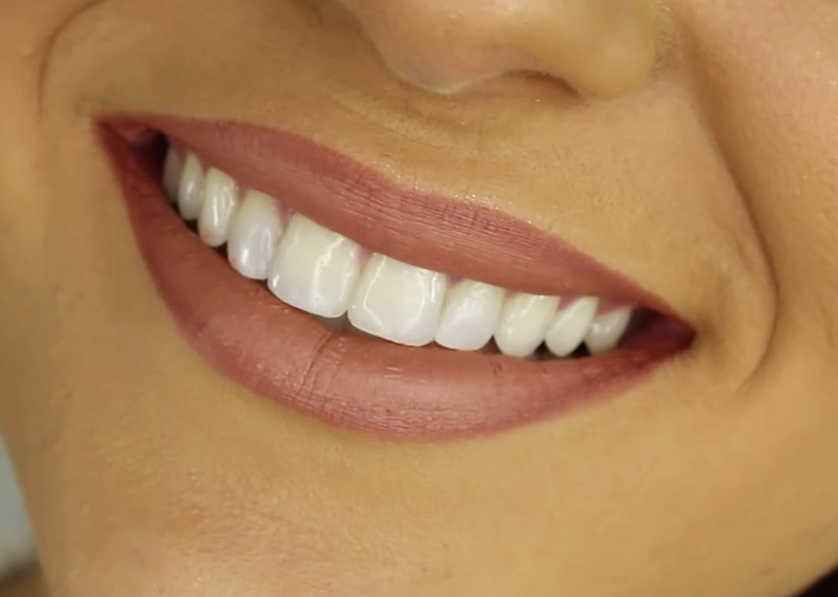 Sonrisa natural y equilibrada para explicar el contorneado dental estético