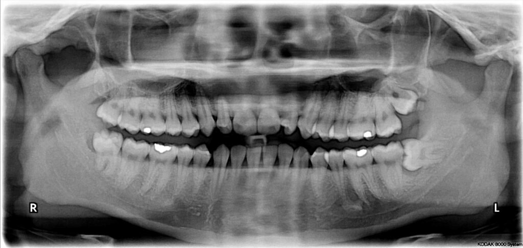 Radiografía dental panorámica con cordales incluidos en la mandíbula
