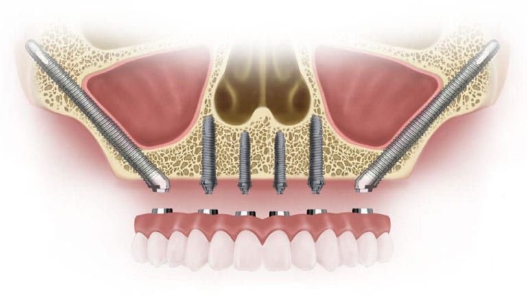 Ilustración clínica de implantes cigomáticos en maxilar superior atrófico