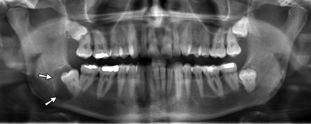 Radiografía panorámica con quiste dentígero mandibular alrededor de una muela del juicio incluida