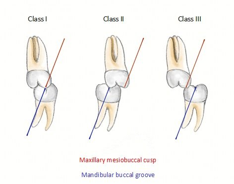 Clasificación de la relación molar en la oclusión dental