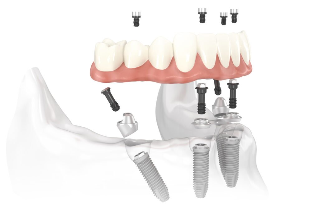 Ilustración de rehabilitación All on Four con cuatro implantes y prótesis fija completa
