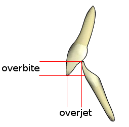 Diagrama dental que compara overbite y overjet en la mordida