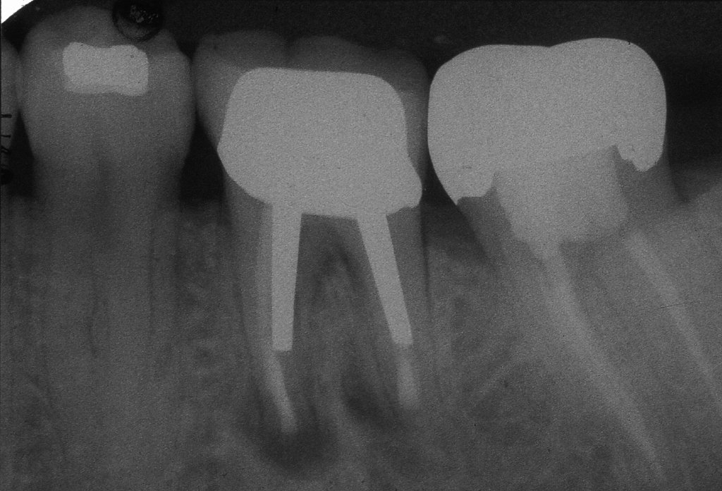Cirugía apical o apicectomía con acceso a la punta de la raíz dental