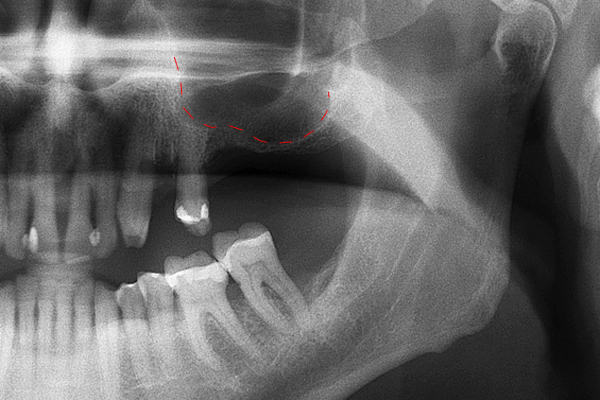Ilustración animada de una elevación de seno maxilar para preparar un implante dental