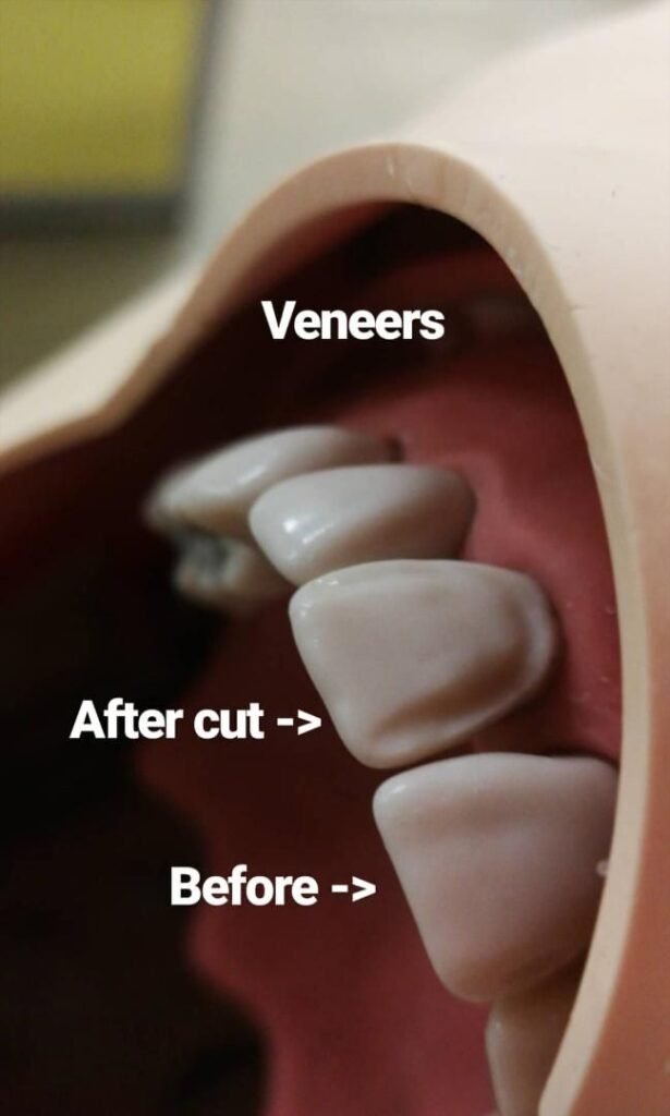 Modelo dental explicativo de una carilla estética en un diente anterior
