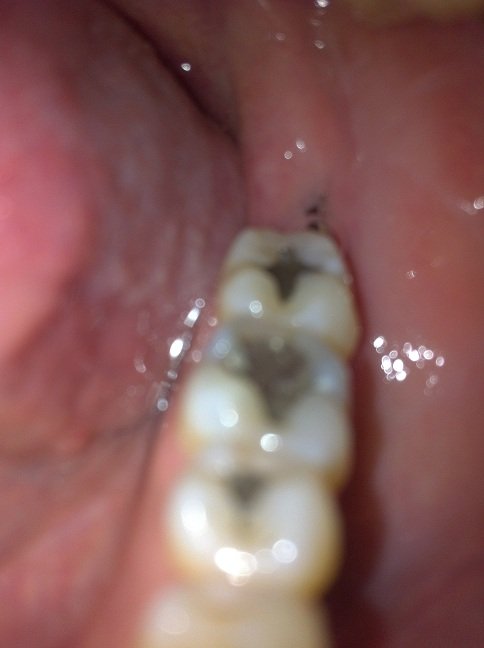 Alvéolo tras extracción de muela del juicio usado como referencia visual para explicar la alveolitis seca