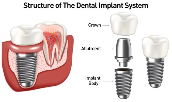 Esquema de implante dental con corona, pilar y cuerpo del implante