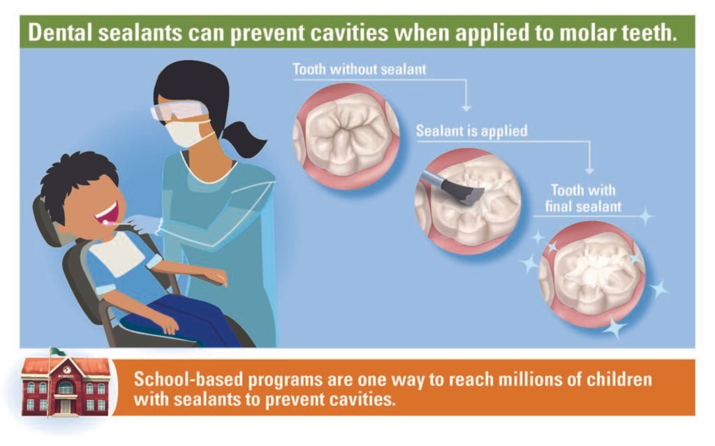 Infografía dental sobre aplicación de selladores en molares infantiles para prevenir caries