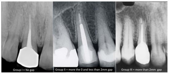 Radiografías periapicales con postes dentales cementados en dientes tratados con endodoncia