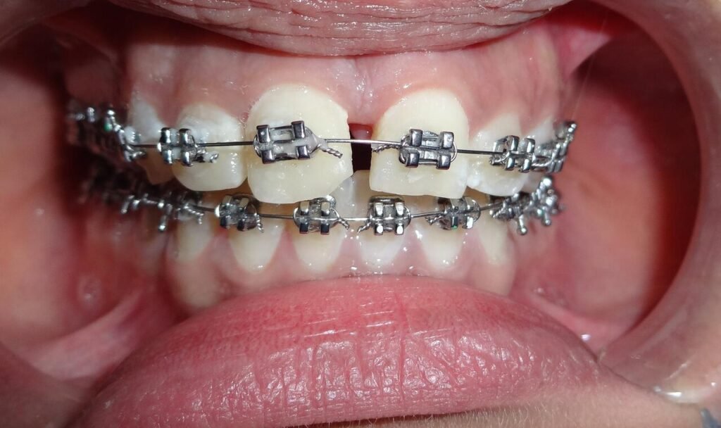 Aparato fijo de ortodoncia con brackets metálicos en dientes superiores e inferiores